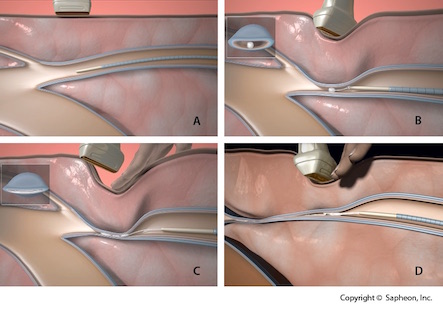 Venenkleber: Stellen Sie eine kostenlose Terminanfrage!